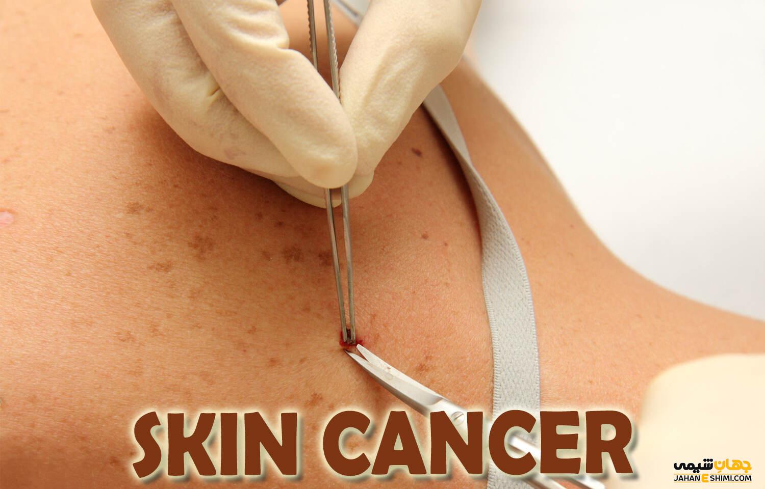 سرطان پوست و نشانه های خطرناک آن را بشناسید!