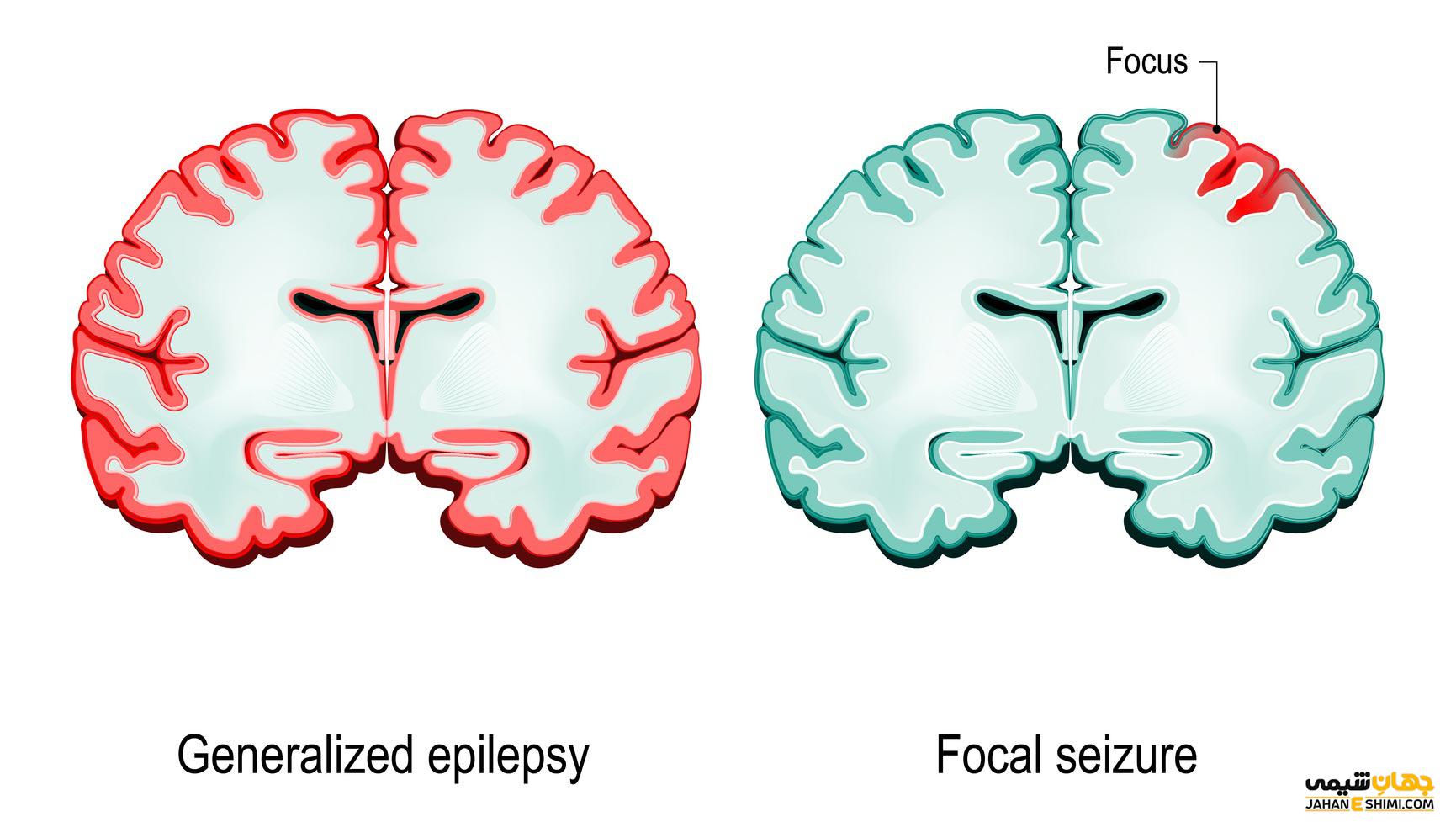 Мозгов эпилепсии. Мозг эпилептика. Эпилепсия мозг генерализованная. Focal Epilepsy. Абсансная эпилепсия.