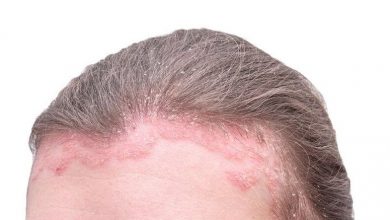 راهنمای خرید بهترین شامپو ضد قارچ پوست سر