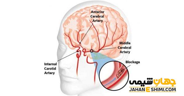 حمله ایسکمی گذرا چیست؟ | دارو و درمان حمله ایسکمی گذرا